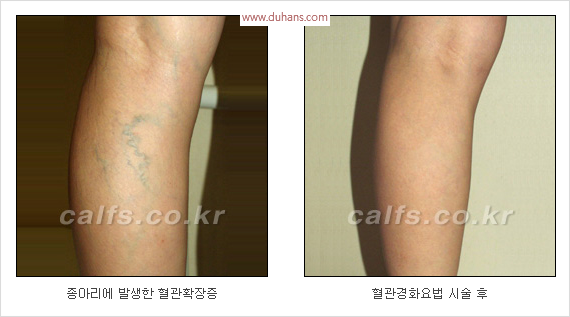 [두한성형외과 경쟁력 종아리성형 리더] - [종아리 성형 안내] 관련 이미지 21