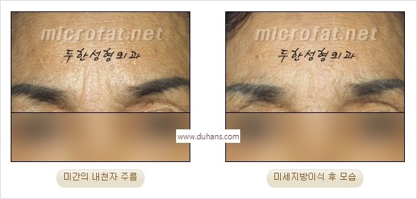 [두한성형외과 경쟁력 주름성형] - [미세지방이식을 이용한 미간주름 제거 효과] 관련 이미지 17