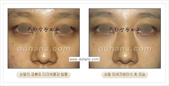 [두한성형외과 경쟁력 눈밑성형] - [꺼진 눈밑, 눈밑 함몰 주름선 눈밑 미세지방이식 안내] 관련 이미지 20