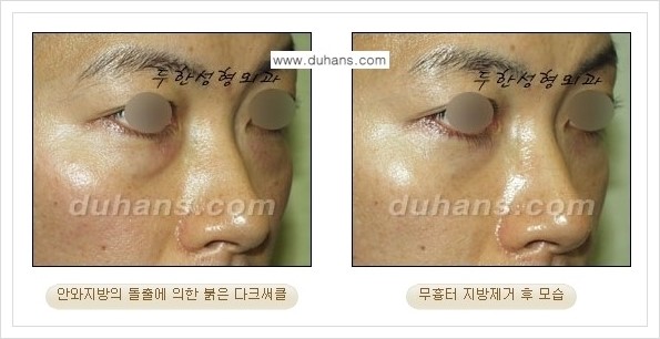 [두한성형외과 경쟁력 안검성형] - [눈밑 지방제거 안내] 관련 이미지 8