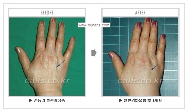 [두한성형외과 정맥류 치료] - [손, 팔 정맥확장증 사진자료 안내 ①] 관련 이미지 1