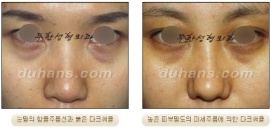 [두한성형외과 미세지방이식] - [다크써클, 눈밑주름 개선] 관련 이미지 1