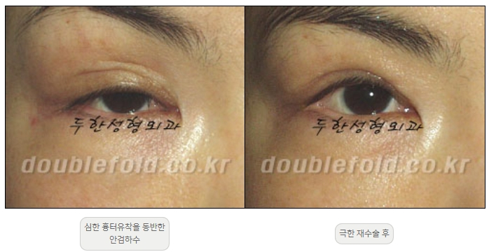 [Duhan Plastic Surgery Double Eyelid Revision] - [Thick Double Eyelid Line] image 48