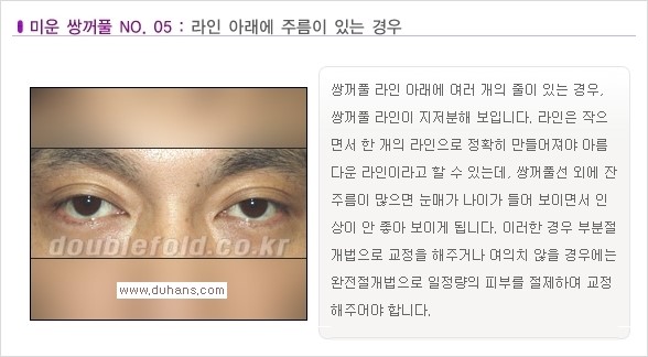 [두한성형외과 경쟁력 쌍꺼풀 재수술, 극한 재수술] - [일반적인 기준의 미운 쌍꺼풀과 아름다운 쌍꺼풀 안내] 관련 이미지 5
