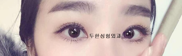 #쌍수 #쌍꺼풀 #쌍가풀 #쌍꺼플 #쌍꺼풀 #매몰 #눈수술 #쌍커풀 관련 이미지 2
