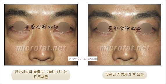 ⁠⁠[두한성형외과 경쟁력 안검성형] - [젊은 눈매를 위한 윗눈꺼풀 지방제거, 눈밑 지방제거] 관련 이미지 22