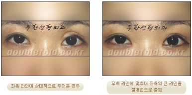 [Duhan Plastic Surgery Eye Surgery] - [Asymmetric Line, Eyelash Eversion, Deep Fixation] image 6