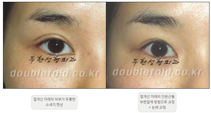 [Double Eyelid Surgery Duhan Plastic Surgery] - [Revision Methods] image 14
