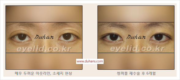 [두한성형외과 경쟁력 눈성형] - [절개법, 매몰법의 수술 방법] 관련 이미지 10
