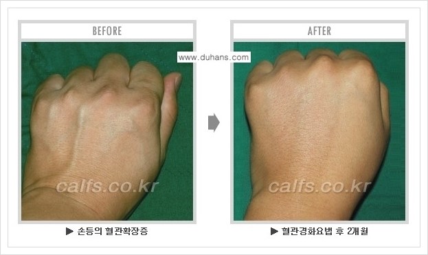 [두한성형외과 정맥류 치료] - [손, 팔 정맥확장증 사진자료 안내 ①] 관련 이미지 5