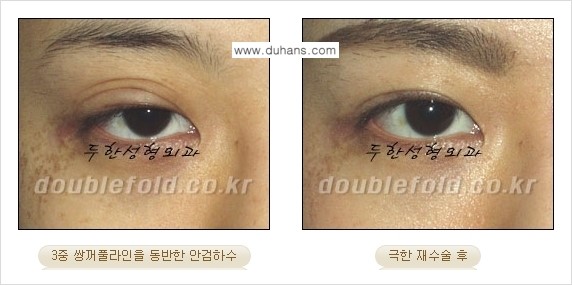 [두한성형외과 경쟁력 쌍꺼풀 재수술, 극한 눈재수술] - [망친 쌍꺼풀을 복원하는 극한 눈재수술] 관련 이미지 11