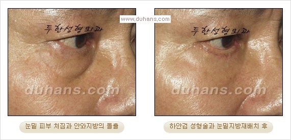 [두한성형외과 경쟁력 다크써클 교정] - [젊어 보이면서 개선된 인상을 주는 하안검 성형술] 관련 이미지 21