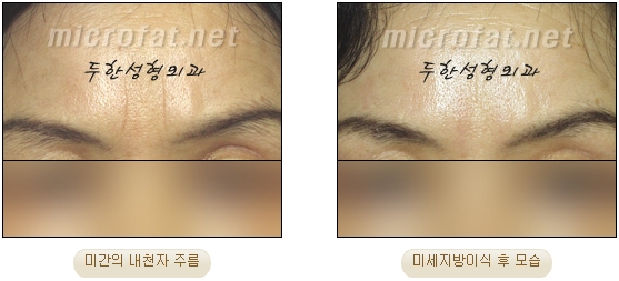 [두한성형외과 자가지방이식] - [미간주름] 관련 이미지 11