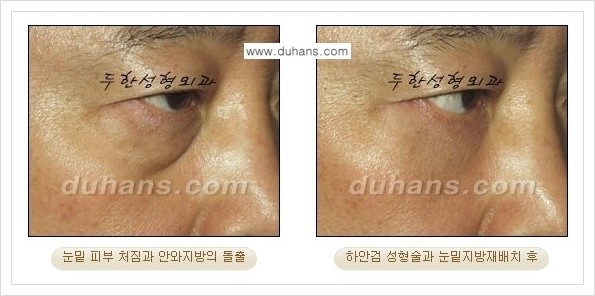 [두한성형외과 경쟁력 눈성형] - [젊은 눈매로의 복원 안검성형] 관련 이미지 28