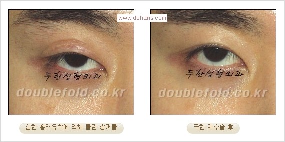 Dr. 컬럼 - 쌍꺼풀 재수술의 부작용을 최소화하는 극한 눈재수술 관련 이미지 7