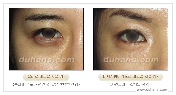 [두한성형외과 경쟁력 눈밑성형] - [눈밑 애교살 시술을 위한 미세지방이식 안내] 관련 이미지 11