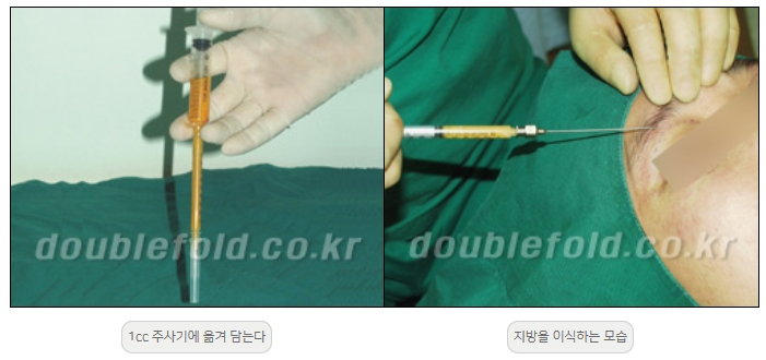 [Duhan Plastic Surgery Double Eyelid Revision] - [Thick Double Eyelid Line] image 17