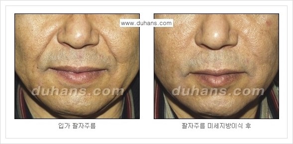 [두한성형외과 경쟁력 주름성형] - [코 옆과 입가에 걸쳐서 형성된 주름을 교정해주는 미세지방이식] 관련 이미지 21