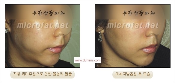 [두한성형외과 경쟁력 미세지방이식] - [지방이식 부작용 교정 모습 안내] 관련 이미지 28