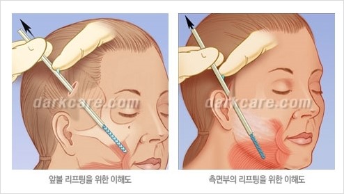 [두한성형외과 경쟁력 주름성형] - [주름제거를 위한 리프팅] 관련 이미지 17