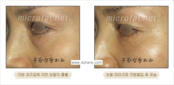 ​[두한성형외과 가을엔 지방흡입을] - [볼살, 눈밑, 턱선 초음파 미세지방흡입] 관련 이미지 1