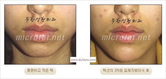 [두한성형외과 경쟁력 안면윤곽 교정] - [자연스럽고 균형있는 턱으로의 복원 미세지방이식과 간편 사각턱 보톡스 안내] 관련 이미지 13