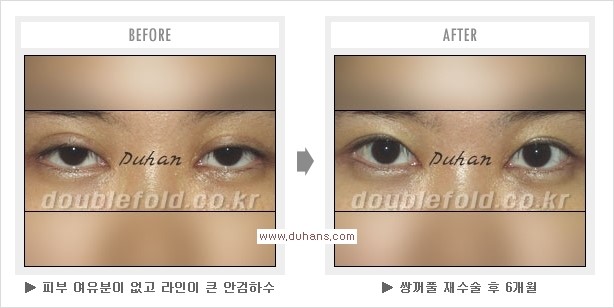 [두한성형외과 경쟁력 쌍꺼풀 재수술, 극한 눈재수술] - [쌍꺼풀 재수술을 위한 검사와 테스트] 관련 이미지 6