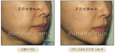 두한성형외과 주름개선 - 주름 HIFU 리프팅 관련 이미지 16