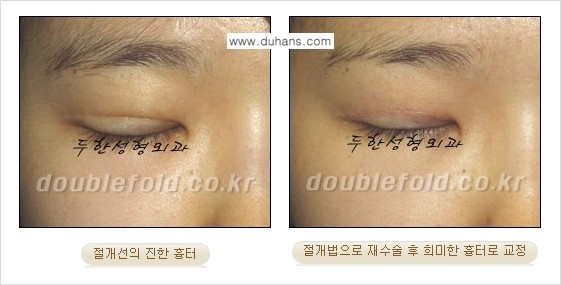 [두한성형외과 함께하는 아름다운 눈매로의 변신] - [흉터선이 진한 경우] 관련 이미지 4