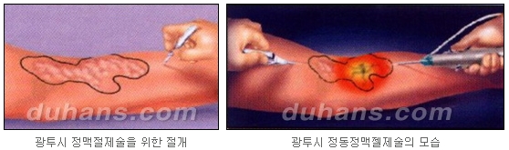 [두한성형외과 정맥류] - [정맥류 시술안내] 관련 이미지 11