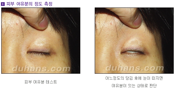 Candidates for Double Eyelid Revision Surgery: Unattractive Double Eyelids, Beautiful Double Eyelids image 3