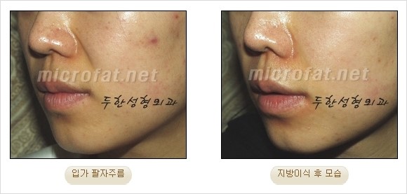 [두한성형외과 경쟁력 안티에이징 동안성형] - [주름이 깊은 푹~ 꺼진 입가 팔자주름 안녕!] 관련 이미지 19