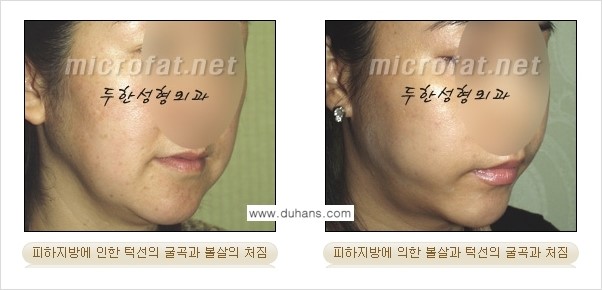 [두한성형외과 겨울엔 지방흡입을] - [통통한 볼살, 두툼한 턱선의 지방흡입 1.] 관련 이미지 2
