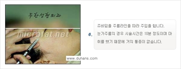 [두한성형외과 경쟁력 퀵성형] - [필러주사(쥬비덤)으로  간단하고 빠르게 주름교정] 관련 이미지 13