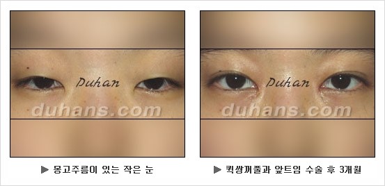 [두한성형외과 경쟁력 눈성형] - [눈성형 방법에 대한 흔한 질문과 답변 안내] 관련 이미지 4