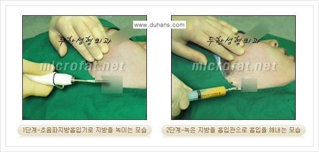 [두한성형외과 경쟁력 미세지방이식] - [타병원에서의 미세지방이식 부작용 교정 방법 안내] 관련 이미지 3