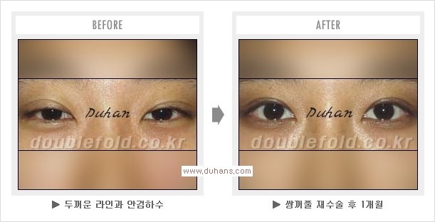 [두한성형외과 경쟁력 눈성형] - [쌍꺼풀 재수술 과정과 쌍꺼풀 재수술 실패의 원인, 쌍꺼풀 재수술의 성공 요건] 관련 이미지 10