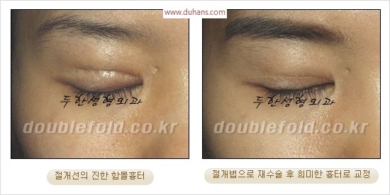 [두한성형외과 경쟁력 쌍꺼풀 재수술 리더] - [쌍꺼풀 흉터선, 쌍꺼풀 흉터 유착 교정술 안내] 관련 이미지 10