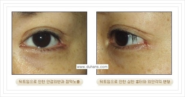 [두한성형외과 경쟁력 쌍꺼풀 재수술, 극한 눈재수술] - [뒤트임 부작용과 뒤트임 교정수술 방법 안내] 관련 이미지 7