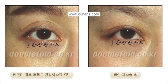 [두한성형외과 경쟁력 눈성형] - [재수술시 유의해야 할 사항과 성공 요건] 관련 이미지 3