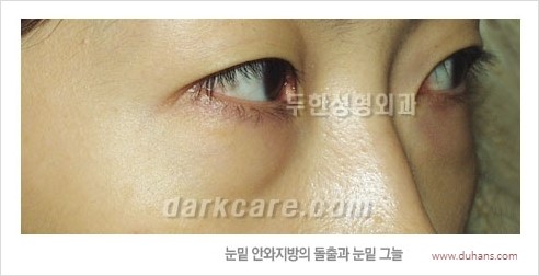 [두한성형외과 경쟁력 눈밑성형] - [눈밑 안와지방 돌출의 무통마취 무흉터 눈밑지방제거 안내] 관련 이미지 2
