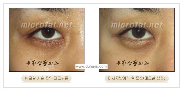 [두한성형외과 경쟁력 눈밑성형] - [눈밑 애교살 미세지방이식 안내] 관련 이미지 11