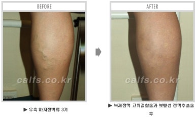 [종아리 두한성형외과] - [나에게 맞는 종아리시술] 관련 이미지 50