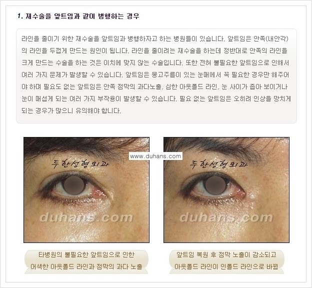 ​​[두한성형외과 경쟁력 쌍꺼풀(눈) 재수술] - [쌍꺼풀(눈) 재수술 실패의 원인 분석 안내] 관련 이미지 3