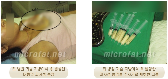 [두한성형외과 지방이식] - [지방이식 부작용 종류와 문제점] 관련 이미지 11