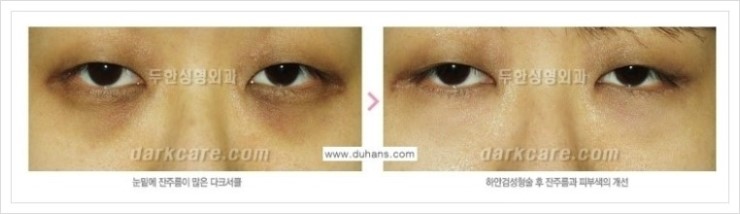 [두한성형외과 경쟁력 눈밑성형] - [눈밑 다크써클 증상과 그 증상에 맞는 치료 방법 안내] 관련 이미지 23