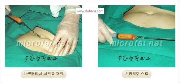 [두한성형외과 경쟁력 미세지방이식] - [애교살 필러 시술의 부작용 교정] 관련 이미지 6