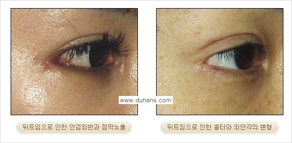 [두한성형외과 NO.1 눈성형] - [뒤트임 수술에 대한 정보] 관련 이미지 10