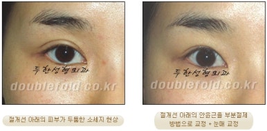 [두한성형외과 쌍커풀재수술] - [심한 소세지눈, 두줄따기, 쌍꺼풀 흉터] 관련 이미지 33