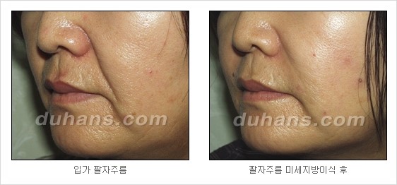 [두한성형외과 경쟁력 주름성형] - [세월의 흔적! 주름을 교정하는 여러 가지 교정 방법] 관련 이미지 28